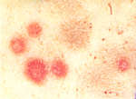 圖3：皮膚近照可見規則紅色直徑約3~5mm之斑點與不整形之棕色斑塊。