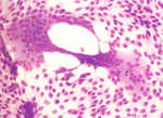 圖7：以RK-13細胞接種罹病豬皮膚乳劑，48小時後可見細胞融合之CPE。劉氏染色x 400。