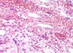 圖6：腎臟髓質部間質纖維芽母細胞及微血管內皮細胞有嗜鹼性核內包涵體。