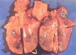 圖6：亞急性型HP；雙肺之肋膜面可見多量纖維素覆蓋，並見肺實質有廣泛散布性肺炎病灶。於肺炎病灶區均呈暗紅色實質肉樣且較濕重；小葉間隔明顯。