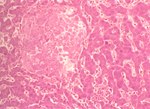 圖5：肝臟組織病變：形成多發小區域凝固樣壞死灶，同時亦有RE細胞形成副傷寒結節(Paratyphoid nodules)、肝竇狀隙大量RE細胞浸潤。