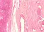 圖6：耳組織病變：真皮層微血管大量粉紅色均質樣小血栓形成。