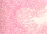 圖7：胃組織病變：黏膜腺體局部凝固樣壞死，周圍微血管亦形成粉紅色均質樣小血栓。