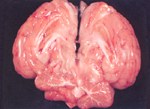 圖2：側腦室內含黃白色膿樣物質團塊、腦膜呈白色混濁。