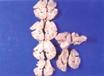 圖3：腦實質經福馬林固定後其切面於側腦室周圍可見黃白色膿樣物質附著。