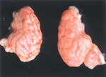 圖2：化膿性腦膜炎的腦部（右）腦膜不透明與混濁，有黃白色膿樣物覆蓋；與正常腦（左）比較其腦溝較不明顯。