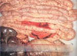 圖2：迴腸腸管變厚而腫脹；由於腺體肥大黏膜呈結節樣皺褶內含血液及血柱，盲結腸含煤焦樣黑色水樣便。