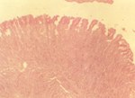 圖3：迴腸黏膜呈大而擴張分枝腺體由許多未成熟、形成擁擠偽複層柱狀上皮細胞所構成（細胞核呈濃染、長紡錘狀）；腺窩內大量壞死細胞碎片及嗜中性球；固有層單核細胞及嗜酸性球浸潤增加H&E。   