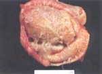 圖4：心外膜常呈絨毛心之病灶。