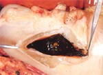 圖2：胃黏膜下層水腫，胃含有黑色內容物。