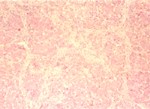 圖3：肝索增生形成索小葉，H&E×60。