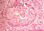 圖5：出現在扁桃腺的嗜伊紅性核內包涵體。