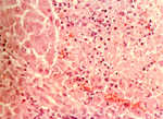 圖7：肝臟壞死灶周邊有數個核內包涵體。