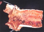圖2：咽喉頭黏膜壞死灶，氣管黏膜充出血及肥厚；並有彌漫性黃褐色纖維素滲出物及血樣液附著。