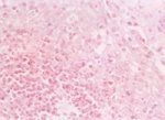 圖5：氣管組織病變：壞死區之變性上皮細胞內可見核內嗜酸性包涵體。