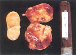 圖1：腸間淋巴（黃白色）腫大約10數倍，腎門淋巴（紅色含血樣液者）亦腫大約10數倍，呈易碎狀。