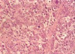 圖4：淋巴結中富含大量淋巴母細胞樣腫瘤細胞，細胞核分裂旺盛。