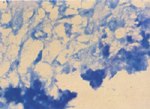 圖4：組織以Zieh1-Neelsen抗酸性染色法染色後可見紅色之結核桿菌，背景由甲基藍複染成藍色。