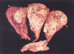圖3：肺實質可見大小不一之膿瘍灶，內有乳黃色樣之濃稠液蓄積。肺門淋巴結腫大，切面下亦可見乾酪樣壞死灶