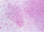 圖4：肺泡腔中聚集大量緻密游走紡錘狀之單核白血球細胞，即通常所謂之燕麥細胞。