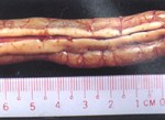 圖5：十二指腸漿膜面及胰實質可見多個紅色凸起小結節，直徑約0.1cm。