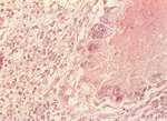 圖3：肝臟大區域壞死，壞死區周圍有許多巨噬細胞及異物巨細並可見到histomonas蟲體