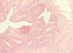 圖4：盲腸固有層有許多淋巴球、巨噬細胞浸潤。黏膜上皮可見histomonas蟲體。