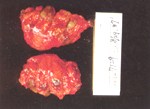 圖1：肺密發大小不一的硬實暗色區域，有些切面尚可見到灰色絲狀物於病灶中央。 