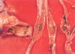 圖2：腸管的集淋小結發生嚴生壞死潰瘍。