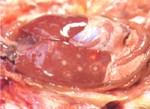 圖2：肝表面多發灰白色結節。