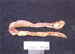 圖3：腸管多發直徑約一公分灰白色結節。