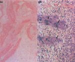 圖4a：膽囊、 黏膜上皮脫落，肌層呈水腫，近漿膜面小血管內有血栓形成 圖4b：脾 、局部RE細胞聚集成小結節 及凝固樣壞死，內含有細菌之菌塊 (如箭頭所示)。