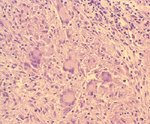 圖3：壞死灶周圍有許多纖維母細胞及類上皮細胞包被。其間有許多核大而淡染且排列在邊緣（呈花圈狀或馬蹄狀排列）之藍罕氏巨細胞。