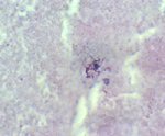 圖4：以抗酸染色 (Zieh1-Neelson) 在乾酪樣壞死區內，大量壞死細胞碎片中，可見呈陽性反應之長絲狀紅染分枝桿菌。