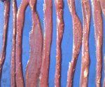 圖2：十二指腸黏膜潮紅，腸壁菲薄。