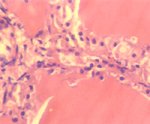 圖4：甲狀腺腺囊細胞數目增多，上皮細胞成柱狀樣。