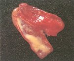 圖1：腸黏膜嚴重充血，腸腔內容充滿透明至白色纖維素。