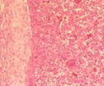 圖6：肝：包膜增厚，纖維結締組織增生，近包膜肝細胞受壓迫變形，呈空泡變性。