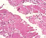 圖8：心肌：局部凝固樣壞死，細胞核消失，細胞質溶解呈粉紅色均質化，橫紋消失，但肌外衣及肌細胞之結構仍存在，同時可見少量炎症細胞浸潤於壞死灶。