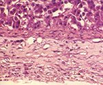 圖4：肝：包膜增厚，近包膜肝細胞被壓迫變形細胞質呈空泡化。