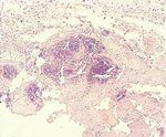 圖7：雞冠：皮下組織水腫、壞死除大量炎症細胞浸潤外，亦可見細菌團塊聚集。