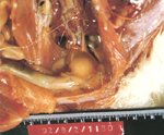 圖2：華氏囊漿膜面，水腫性肥厚，呈水球狀，大量炎症滲出液聚集於漿膜面。