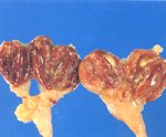 圖3：華氏囊腔可見黏液或黃白色乾酪樣物，黏膜面水腫，瀰漫性充出血或萎縮。