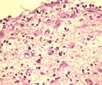 圖4：軟化區域中，星形細胞有增生現象，其細胞質亦發生腫脹情形。