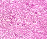 圖3：在肝臟切片下可見大區域的液化性壞死，其中含壞死碎片及少量嗜中性球，並可見少量的阿米巴增殖體(PAS染色)。