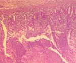 圖4：H&E染色下在骨黏膜可見嚴重壞死灶，並覆蓋很厚的纖維素和黏液樣的物質，其中並可見大量的阿米巴增殖體。