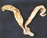 圖1：盲腸可見腸壁明顯增厚，並有大量結節狀物 (0.2~0.5×0.2~0.6cm) 突出於黏膜表面。 