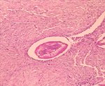 圖2：盲腸之黏膜下層可見增生的纖維芽細胞 (fibroblast) 排列緊密，其中並有蟲體埋於其中。