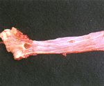 圖2：食道黏膜表面可見白色偽膜樣物質覆蓋，其中並可見小區域的潰瘍斑。