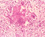圖3：肺臟壞死區周圍有大量多核巨細胞 ， 結締組織增生。H&E 100 X。